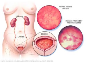 BPC-157: Promising Relief for Interstitial Cystitis Sufferers