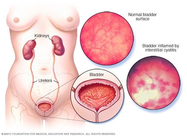 BPC-157: Promising Relief for Interstitial Cystitis Sufferers